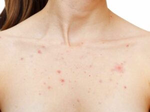 acne on a woman's chest