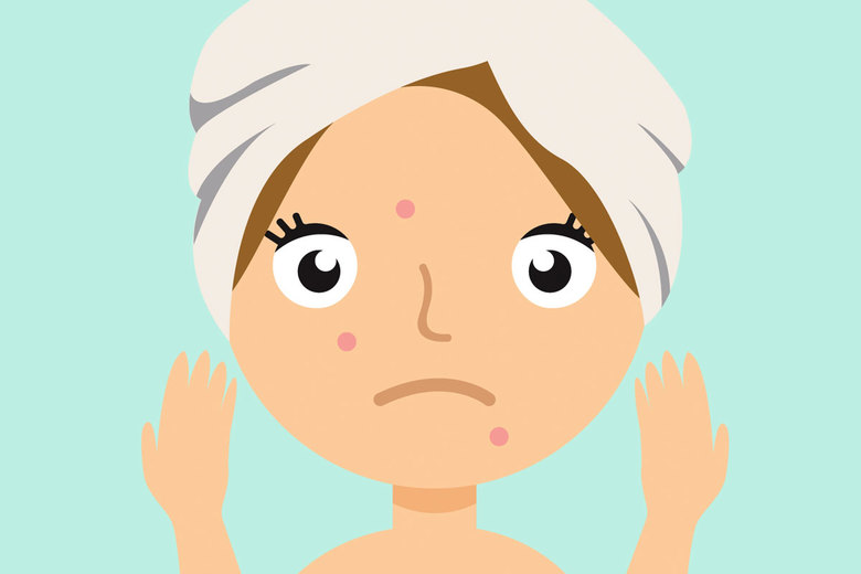 Hormonal Acne: Causes, Types, Treatments, And Prevention