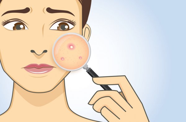 woman finding acne with magnifier illustration