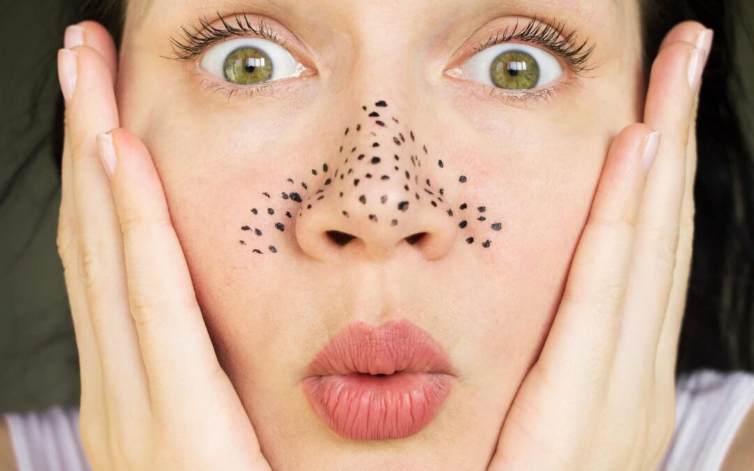 How To Get Rid Of Blackheads