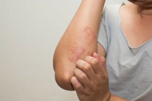 a woman suffering from scabies