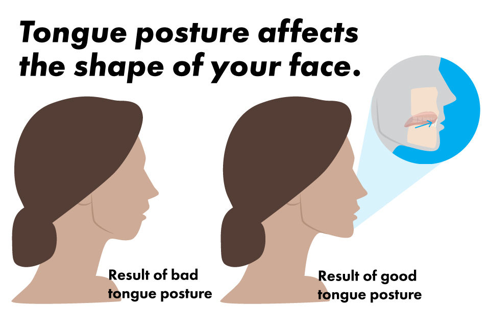results of good and bad tongue posture