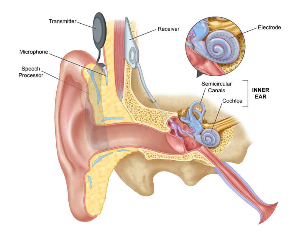 cochlear implant illustration