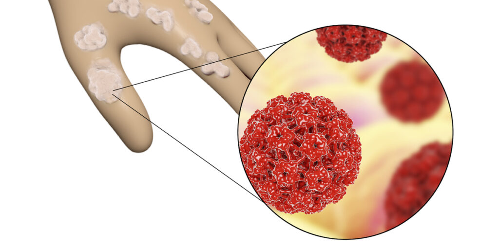 HPV infection