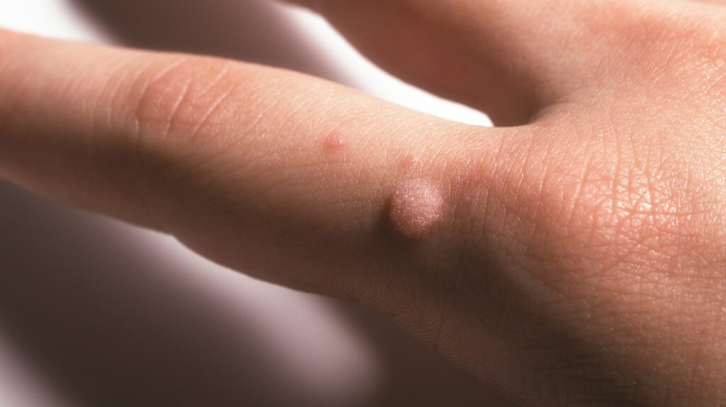 HPV warts