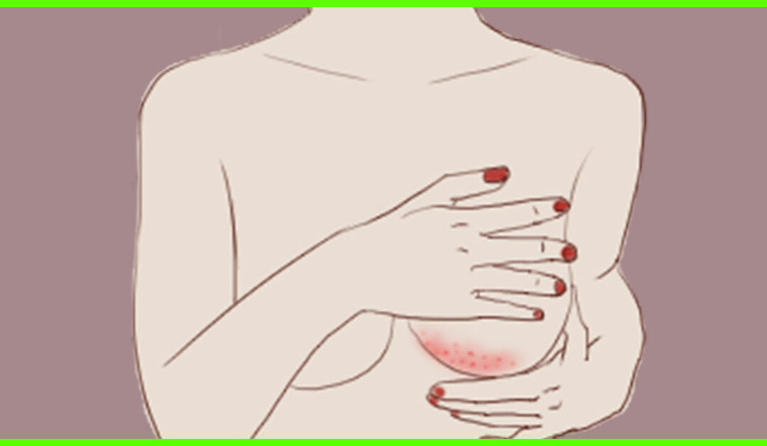 rashes under breasts