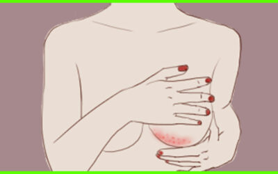 Rash Under Your Breasts: What You Need To Know