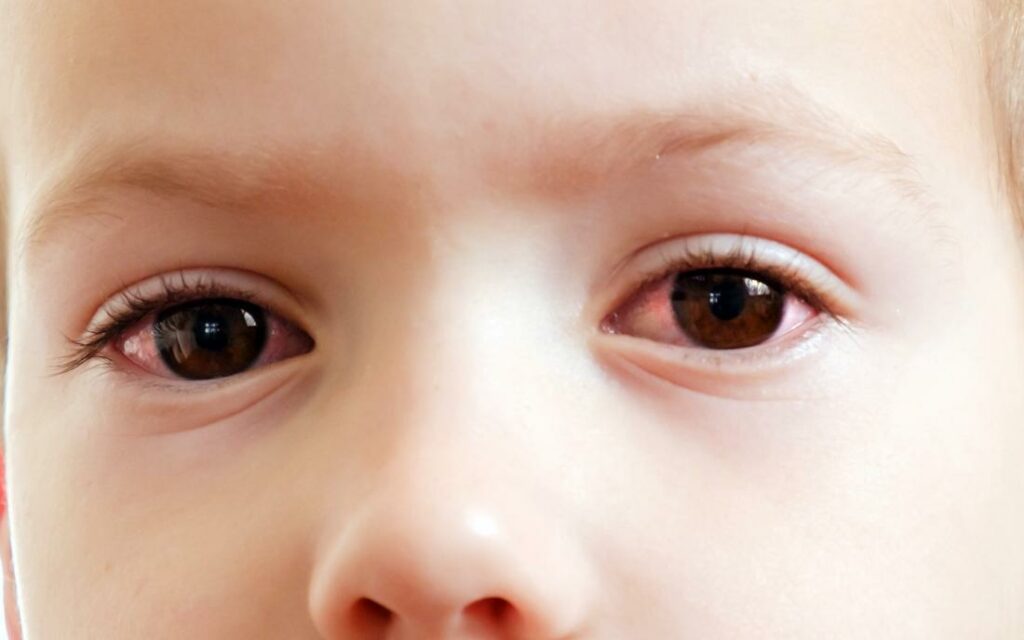 a toddler with pink eye
