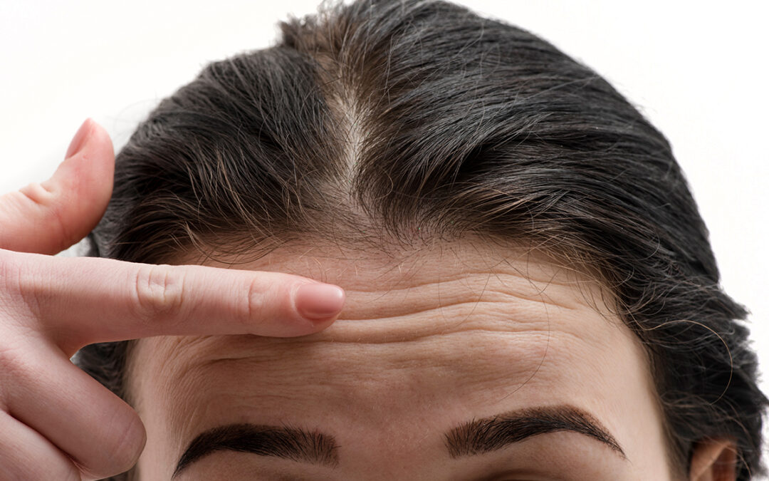 Forehead Wrinkles: Best Ways to Minimise and Avoid them