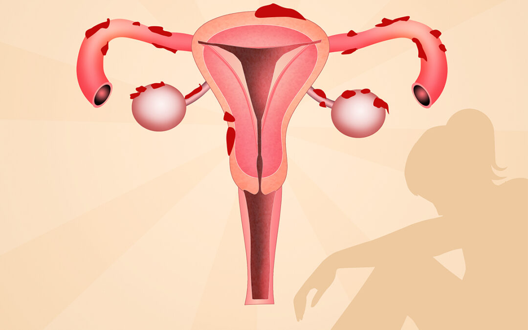 Endometriosis Symptoms: What Are They? How Can You Treat Them?