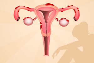 endometriosis symptoms