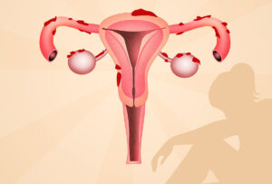 endometriosis symptoms