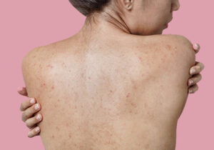 back acne - body acne