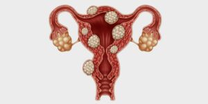 fibroids