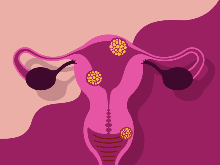 bacterial vaginosis illustration